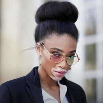 25 de junio: Día Mundial del Vitiligo