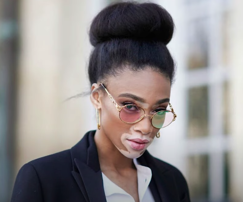 25 de junio: Día Mundial del Vitiligo 25 de junio: Día Mundial del Vitiligo